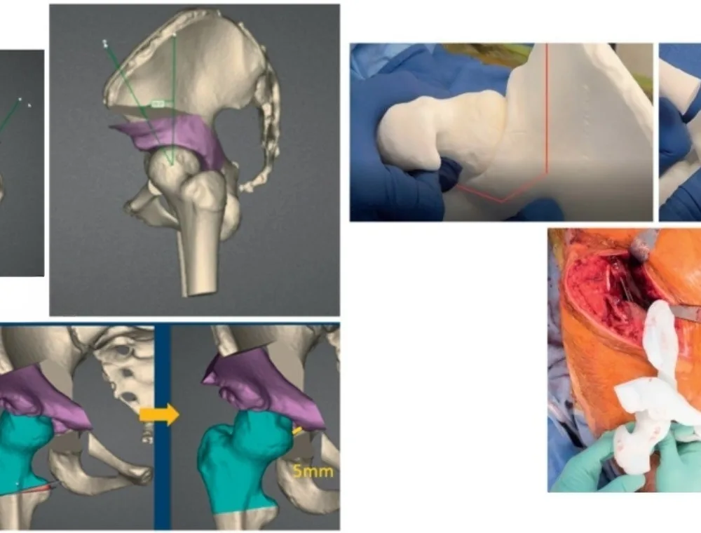 Osteotomía acetabular. Planificación de la corrección del acetábulo sobre la anatomía real de la cadera.