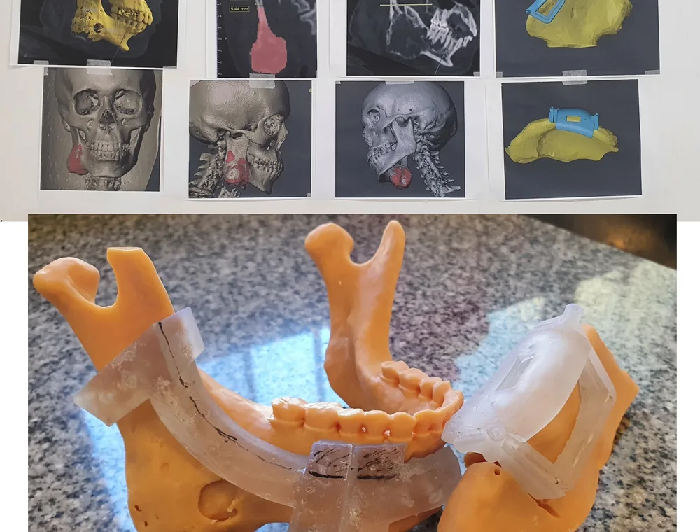 Osteotomía mandibular. Biomodelos del cráneo y guía de corte para planificar la osteotomía antes de entrar.