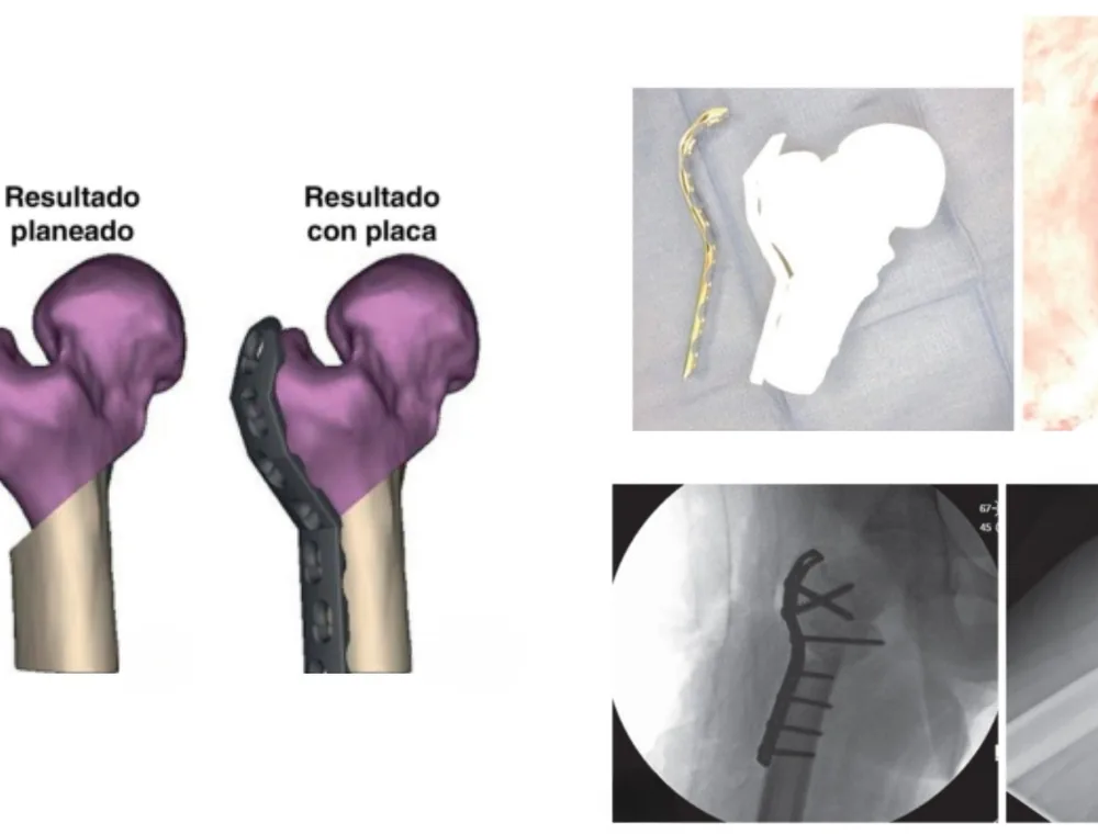 Premoldeado de placa. La placa se ajusta sobre el biomodelo antes de la cirugía: resultado planificado frente a resultado con placa.