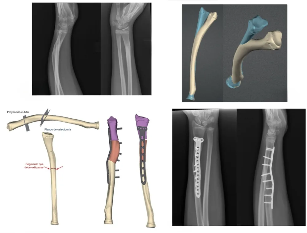 Osteotomía de radio y cúbito. Corrección planificada en 3D y verificada con el control radiográfico.