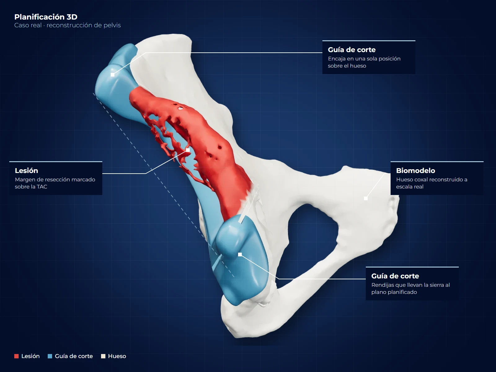 Lámina de planificación 3D de una pelvis: lesión, guías de corte y biomodelo señalados