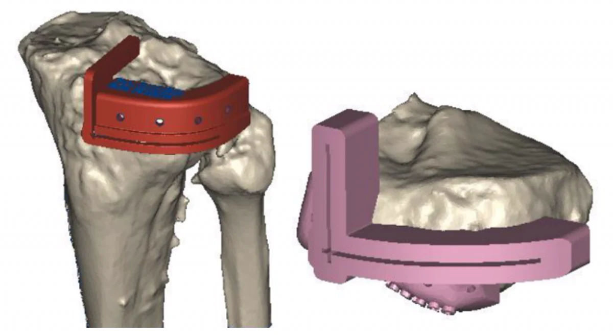Guías de corte diseñadas sobre el modelo 3D de una rodilla