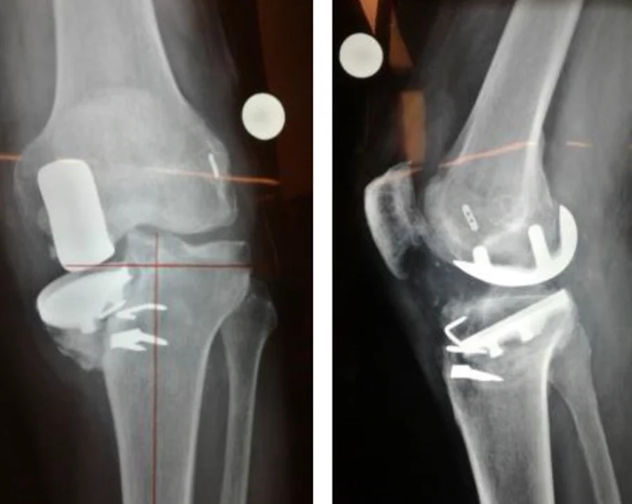 Radiografía preoperatoria. El punto de partida: la rodilla antes de la planificación.
