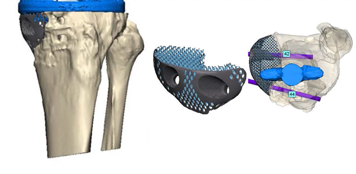 Diseño de un implante tibial poroso a medida